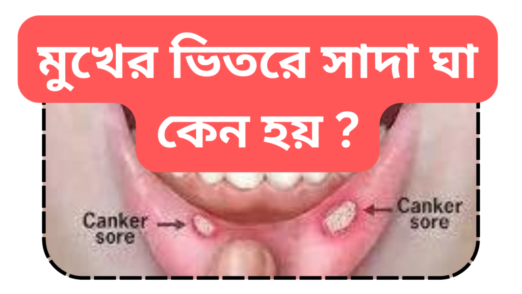 মুখের ভিতরে সাদা ঘা কেন হয়